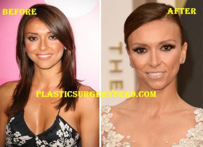 Giuliana Rancic Botox