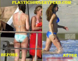 Kate Middleton Butt Implants
