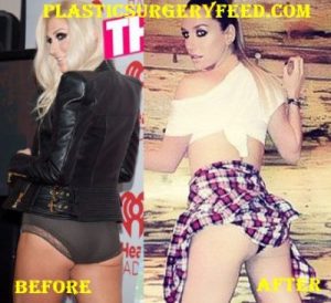 Kesha Butt Implants