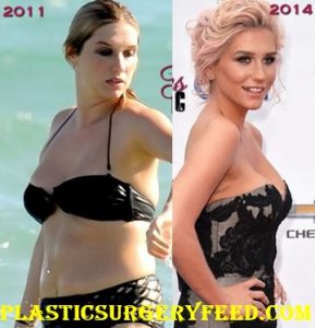 Kesha Liposuction