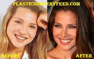 Elsa Pataky Nose Job and Eyelid Surgery