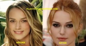 Keira Knightley Lip Implants