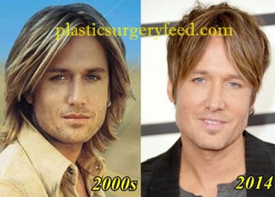 Keith Urban Botox