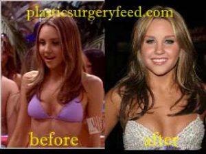 Amanda Bynes Breast Implant