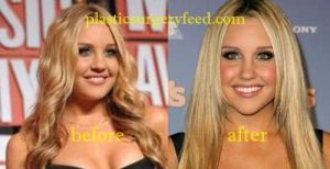 Amanda Bynes Cheek Implant