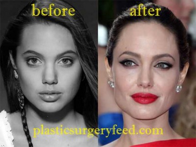Angelina Jolie Botox