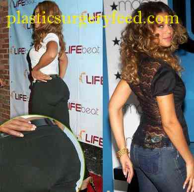 Beyonce Buttock Implant
