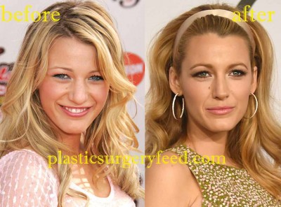 Blake Lively plastic surgery for nose job