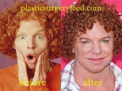 Carrot Top Botox