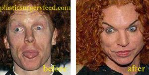 Carrot Top Plastic Surgery