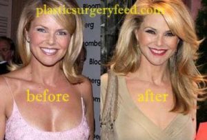 Christie Brinkley Botox anfd Facelift