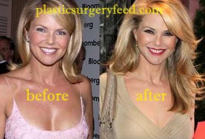 Christie Brinkley Botox anfd Facelift