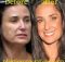 Demi Moore Botox Surgery