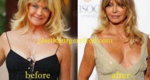 Goldie Hawn Breast Implant
