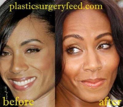 Jada Pinkett Smith Botox