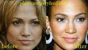 Jennifer Lopez Lips Implant and Botox