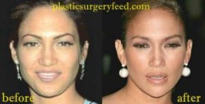 Jennifer Lopez Nose Job