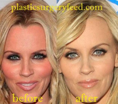 Jenny McCarthy Facelift