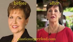 Joyce Meyer Lip Injection