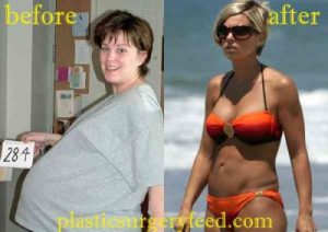 Kate Gosselin Tummy Tuck