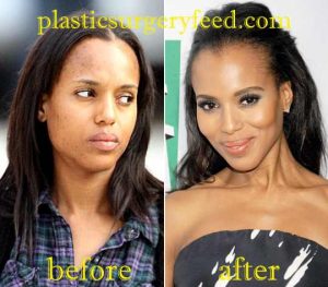 Kerry Washington Botox