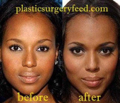 Kerry Washington Lip Implant