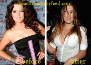 Kloe Kardashian Breast Implants