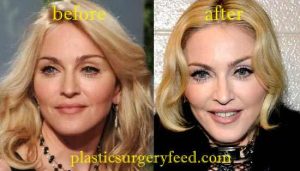 Madonna Facial Enhancement