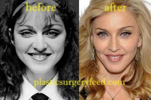 Madonna Jaw Enhancement