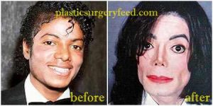 Michael Jackson Skin Whitening