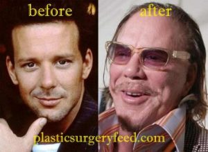 Mickey Rourke Nose Job