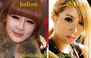 Park Bom Eyelift Surgery