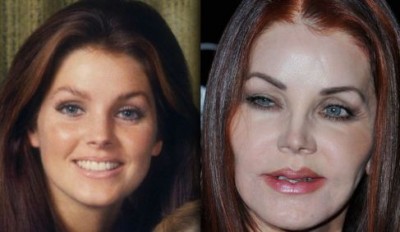 Priscilla Presley Botox