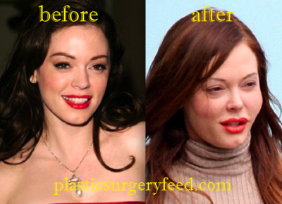 Rose McGowan Cheek Filler