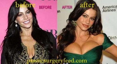Sofia Vergara Breast Implants
