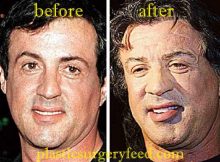 Sylvester Stallone Facelift