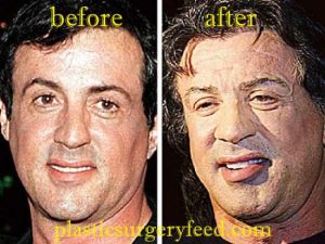 Sylvester Stallone Facelift