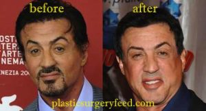 Sylvester Stallone Forehead Surgery