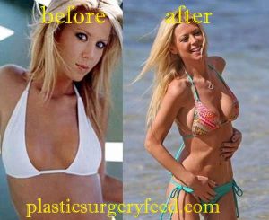 Tara Reid Breast Implant