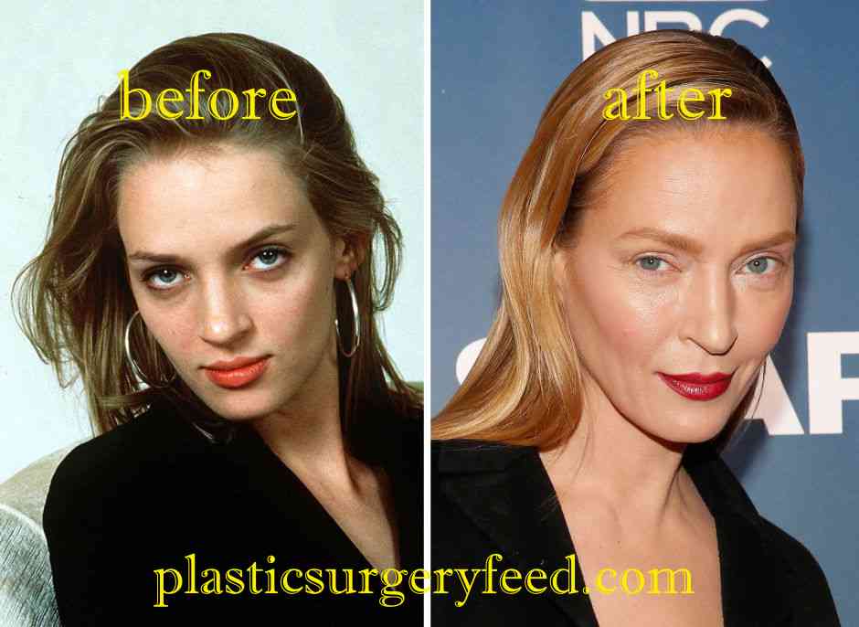 Uma Thurman Cheek Implants - Plastic Surgery Feed
