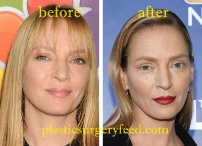 Uma Thurman Nose Job Rhinoplasty