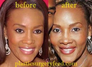 Vivica Fox Lips Enhancement