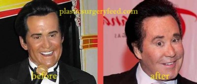 Wayne Newton Botox