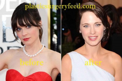 Zooey Deschanel Botox