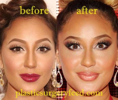 Adrienne Bailon Lip Implant