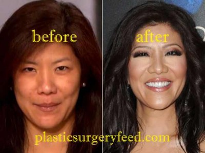 Julie Chen Blepharoplasty