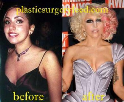 Lady Gaga Breast Implant