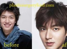 Lee Min Ho Plastic Surgery Nose Job