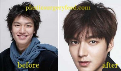 Lee Min Ho Plastic Surgery Nose Job