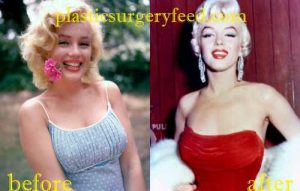Marilyn Monroe Breast Implant